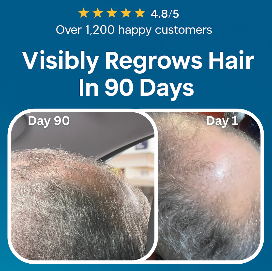 Micro-Infusion Peptide System For Hair Regrowth